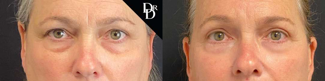 Eyelid Surgery before and after photos by Dr. Demetri Arnaoutakis in Tampa, FL