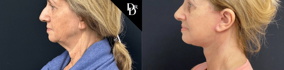 Facelift Before And After Photos By Dr. Demetri Arnaoutakis In Tampa, Fl