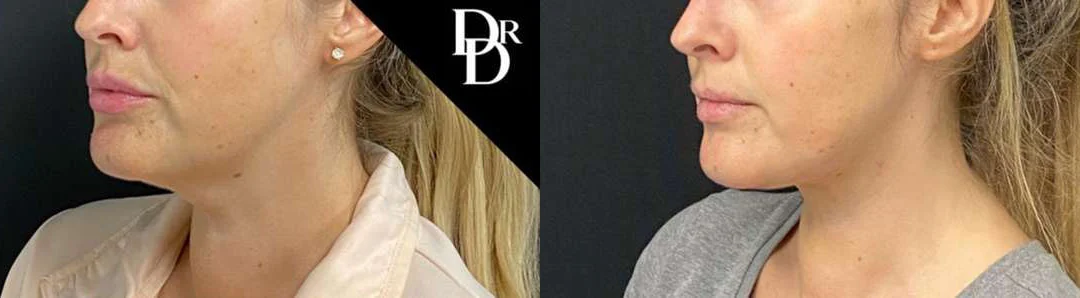 Facetite Before And After Photos By Dr. Demetri Arnaoutakis In Tampa, Fl
