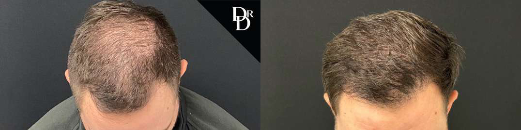 Hair Transplant Before And After Photos By Dr. Demetri Arnaoutakis In Tampa, Fl