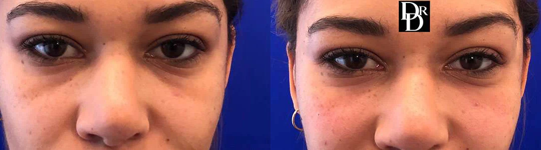 Injectable/Dermal Fillers Before And After Photos By Dr. Demetri Arnaoutakis In Tampa, Fl