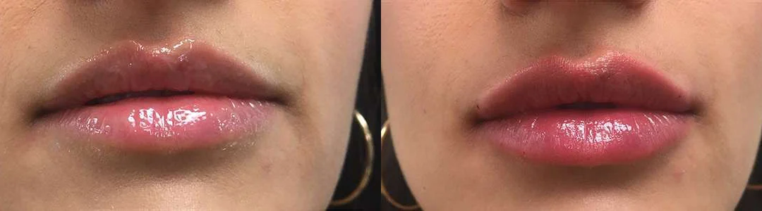Injectable/Dermal Fillers Before And After Photos By Dr. Demetri Arnaoutakis In Tampa, Fl