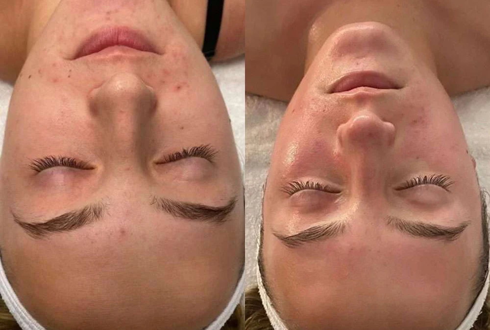 Microneedling Before And After Photos By Dr. Demetri Arnaoutakis In Tampa, Fl