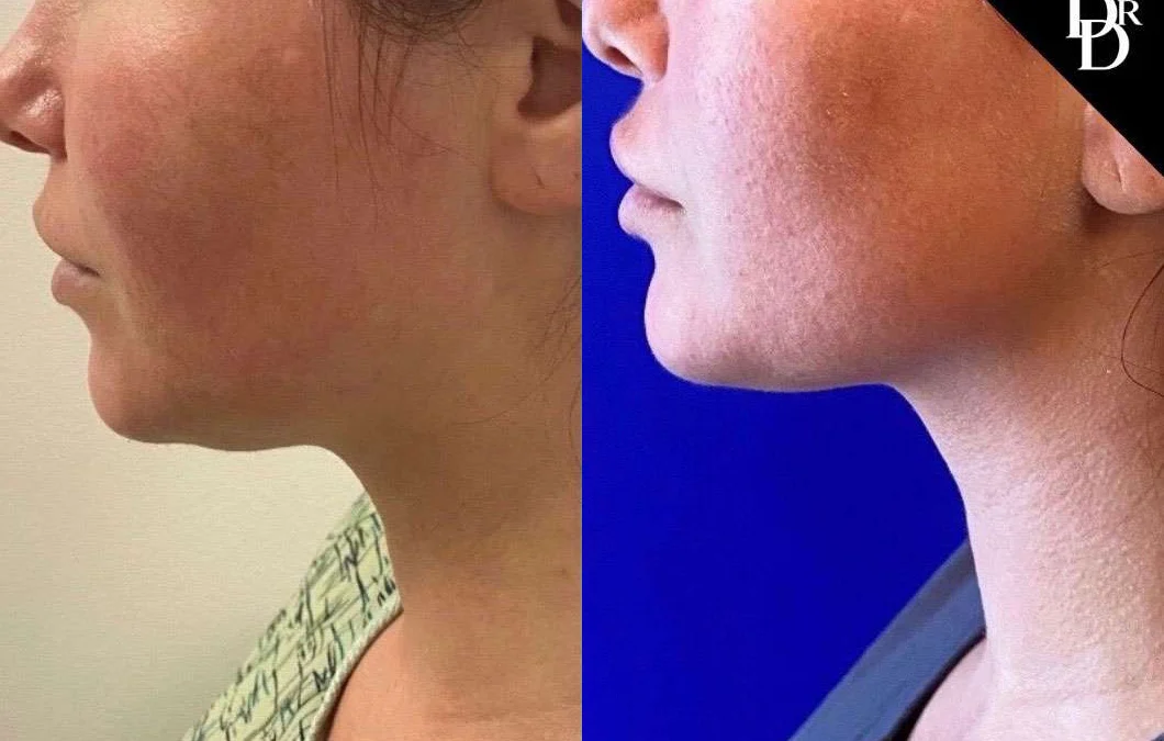 Morpheus8 Before And After Photos By Dr. Demetri Arnaoutakis In Tampa, Fl