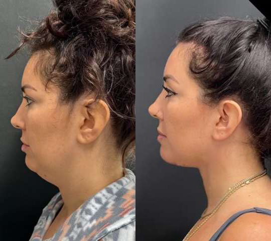 Neck Lift before and after photos by Dr. Demetri Arnaoutakis in Tampa, FL