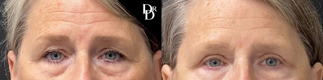 Eyelid Surgery before and after photos by Dr. Demetri Arnaoutakis in Tampa, FL