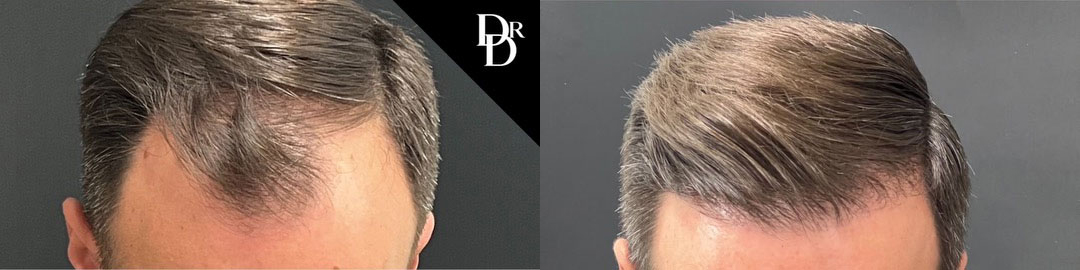 Hair Transplant Before And After Photos By Dr. Demetri Arnaoutakis In Tampa, Fl