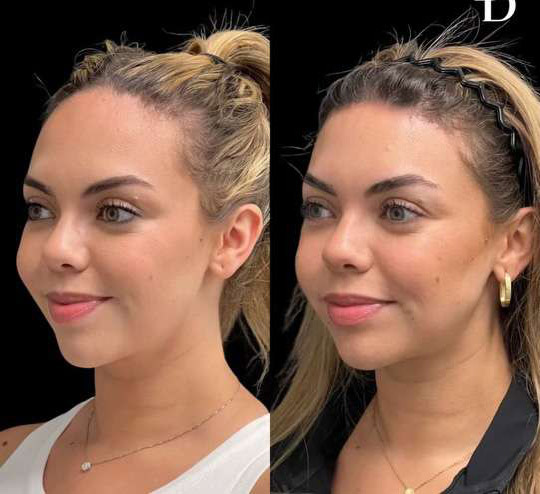 Hairline Lowering Surgery Before And After Photos By Dr. Demetri Arnaoutakis In Tampa, Fl