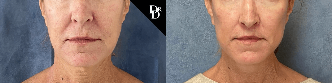 Lip Lift before and after photos by Dr. Demetri Arnaoutakis in Tampa, FL