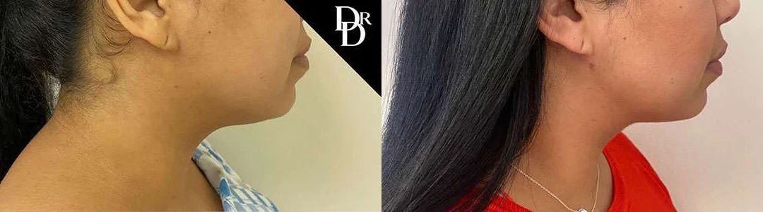 Morpheus8 Before And After Photos By Dr. Demetri Arnaoutakis In Tampa, Fl