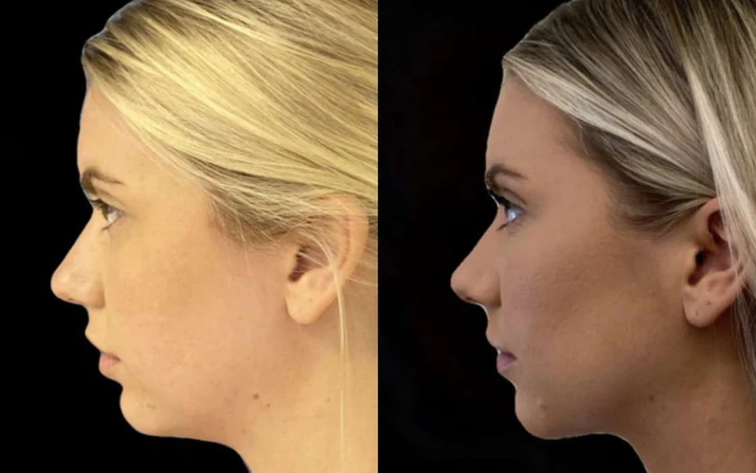 Neck Lift Before And After Photos By Dr. Demetri Arnaoutakis In Tampa, Fl