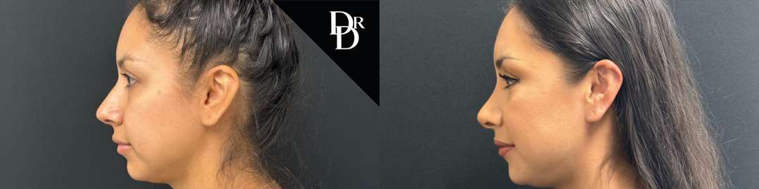 Rhinoplasty before and after photos by Dr. Demetri Arnaoutakis in Tampa, FL