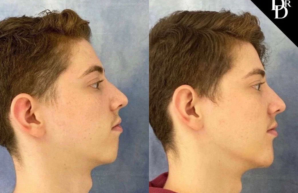 Chin Augmentation before and after photos by Dr. Demetri Arnaoutakis in Tampa, FL
