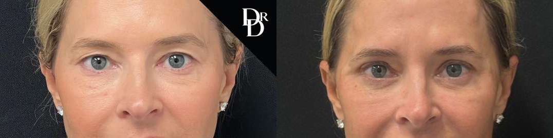 Eyelid Surgery before and after photos by Dr. Demetri Arnaoutakis in Tampa, FL