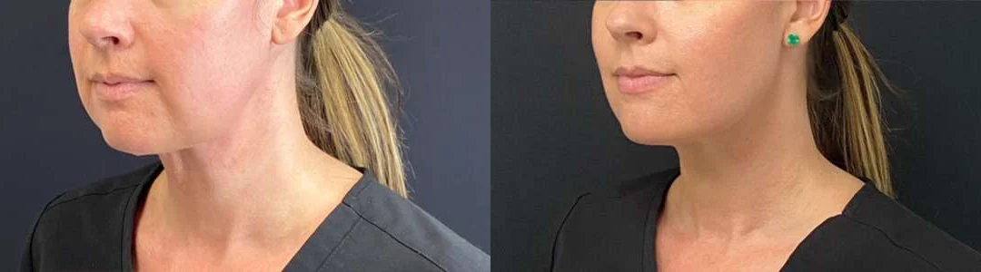 Facetite Before And After Photos By Dr. Demetri Arnaoutakis In Tampa, Fl