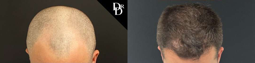 Hair Transplant Before And After Photos By Dr. Demetri Arnaoutakis In Tampa, Fl
