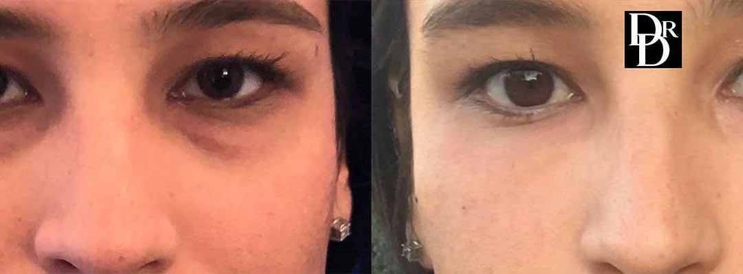 Injectable/Dermal Fillers Before And After Photos By Dr. Demetri Arnaoutakis In Tampa, Fl