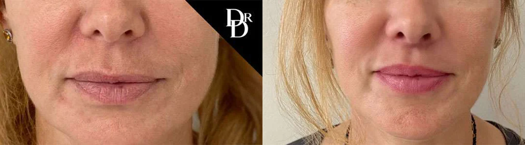 Lip Lift before and after photos by Dr. Demetri Arnaoutakis in Tampa, FL