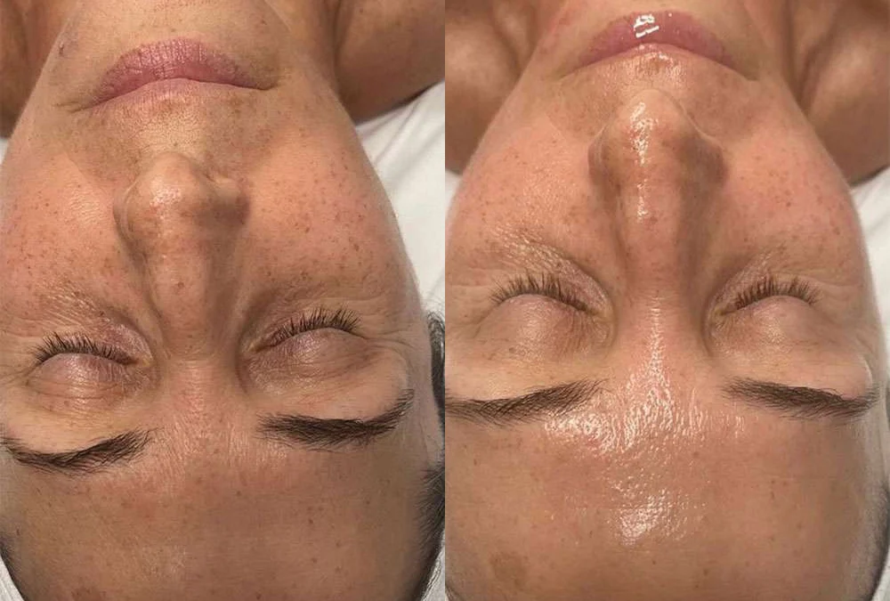Microneedling Before And After Photos By Dr. Demetri Arnaoutakis In Tampa, Fl