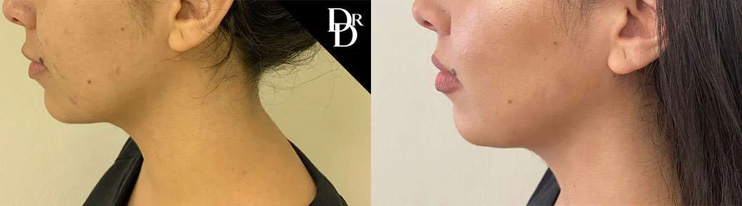 Morpheus8 Before And After Photos By Dr. Demetri Arnaoutakis In Tampa, Fl