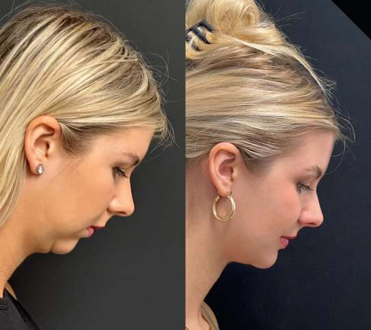 Neck Lift Before And After Photos By Dr. Demetri Arnaoutakis In Tampa, Fl