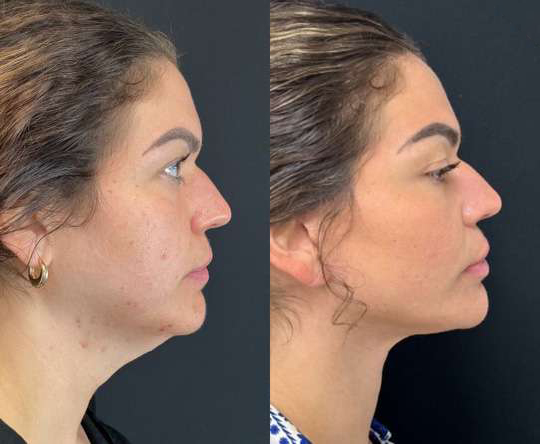 Neck Lift before and after photos by Dr. Demetri Arnaoutakis in Tampa, FL