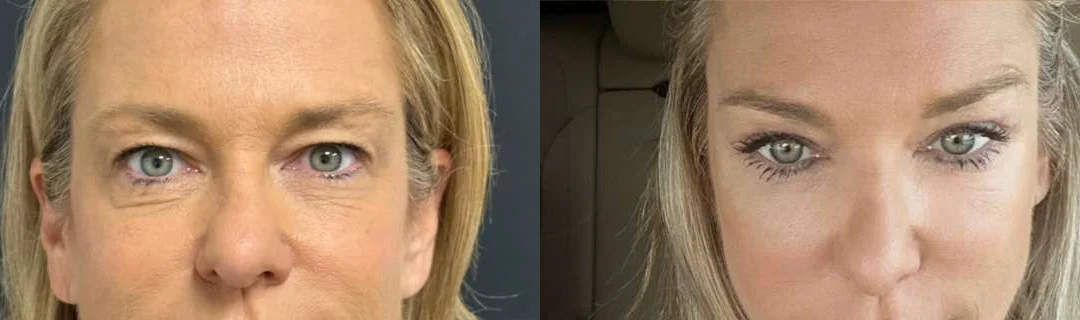 Eyelid Surgery before and after photos by Dr. Demetri Arnaoutakis in Tampa, FL