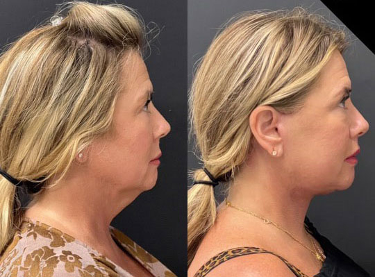 Facelift Before And After Photos By Dr. Demetri Arnaoutakis In Tampa, Fl