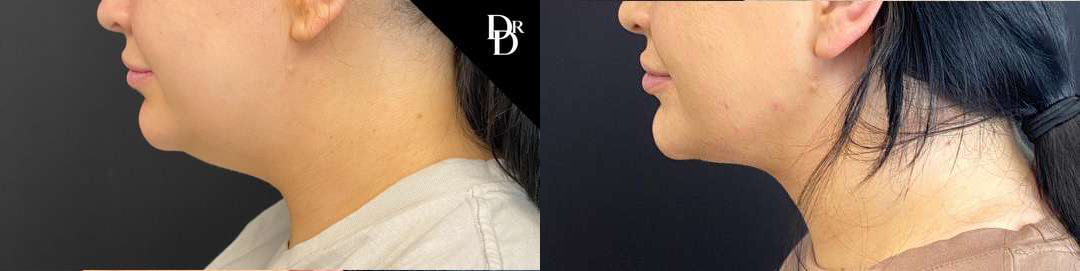 Facetite Before And After Photos By Dr. Demetri Arnaoutakis In Tampa, Fl
