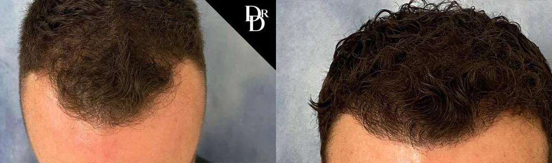Hair Transplant Before And After Photos By Dr. Demetri Arnaoutakis In Tampa, Fl