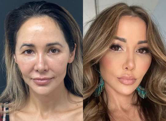 Hairline Lowering Surgery Before And After Photos By Dr. Demetri Arnaoutakis In Tampa, Fl