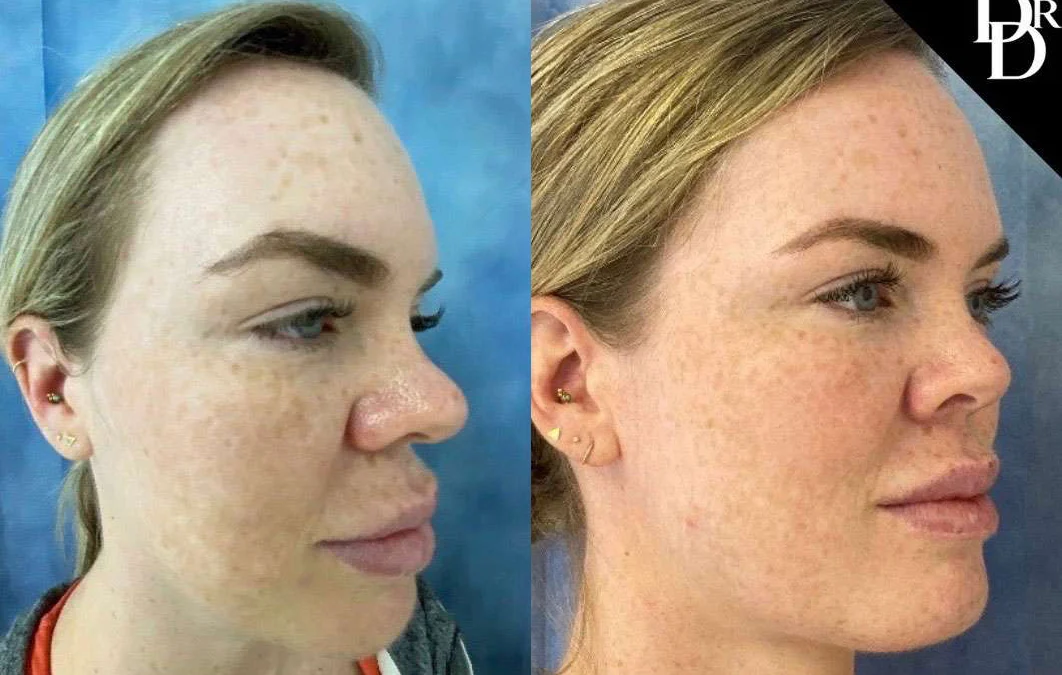 Morpheus8 Before And After Photos By Dr. Demetri Arnaoutakis In Tampa, Fl