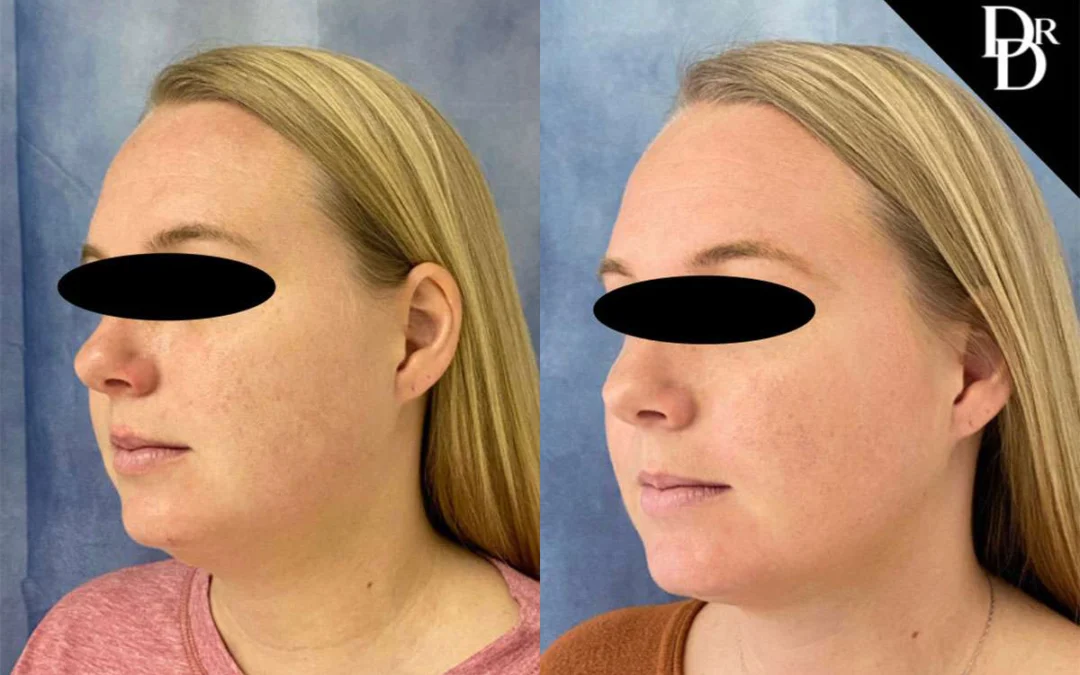 Neck Lift Before And After Photos By Dr. Demetri Arnaoutakis In Tampa, Fl