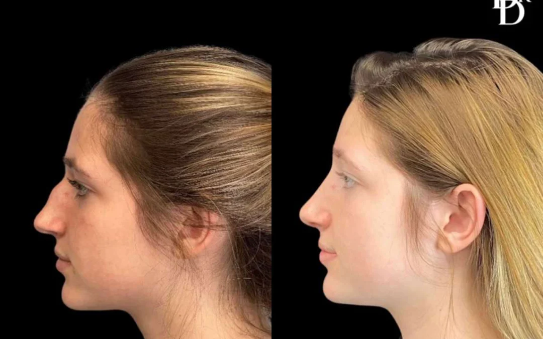 Rhinoplasty before and after photos by Dr. Demetri Arnaoutakis in Tampa, FL