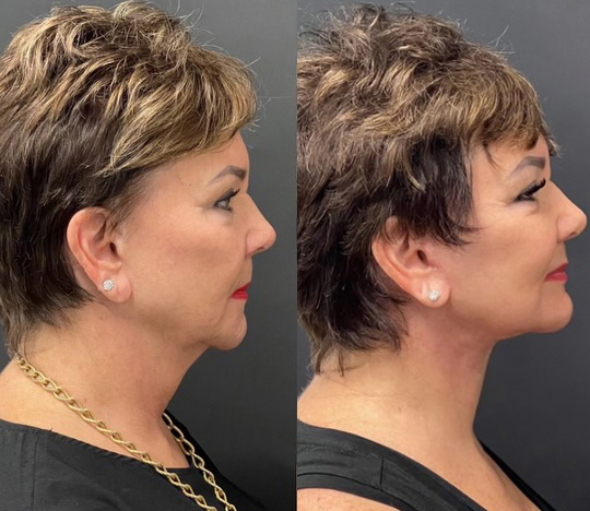 Neck Lift before and after photos by Dr. Demetri Arnaoutakis in Tampa, FL