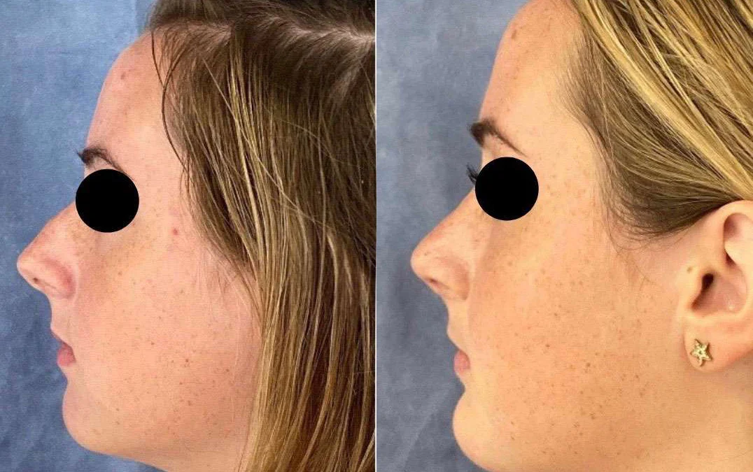 Chin Augmentation before and after photos by Dr. Demetri Arnaoutakis in Tampa, FL