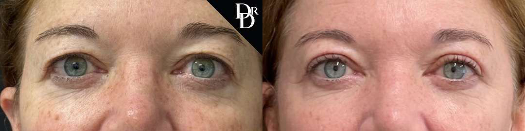 Eyelid Surgery before and after photos by Dr. Demetri Arnaoutakis in Tampa, FL