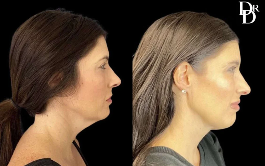 Facetite Before And After Photos By Dr. Demetri Arnaoutakis In Tampa, Fl