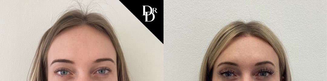 Hairline Lowering Surgery Before And After Photos By Dr. Demetri Arnaoutakis In Tampa, Fl