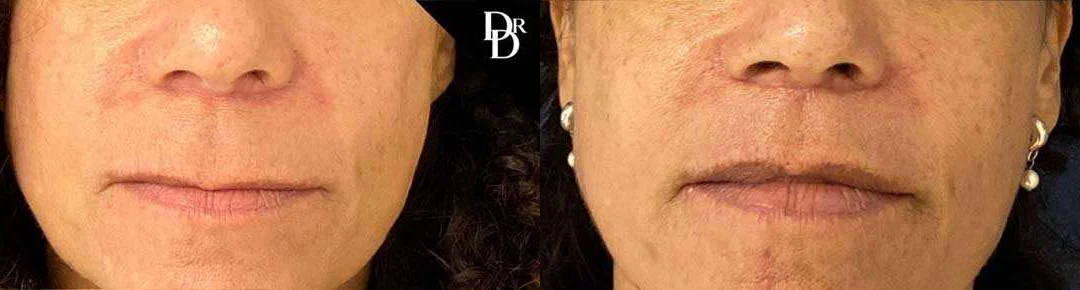 Lip Lift before and after photos by Dr. Demetri Arnaoutakis in Tampa, FL