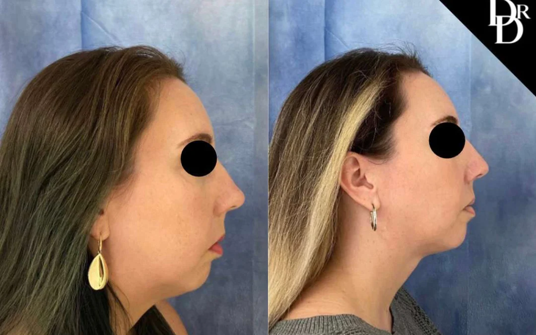 Morpheus8 Before And After Photos By Dr. Demetri Arnaoutakis In Tampa, Fl