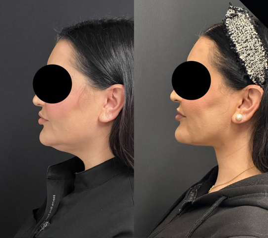 Neck Lift Before And After Photos By Dr. Demetri Arnaoutakis In Tampa, Fl