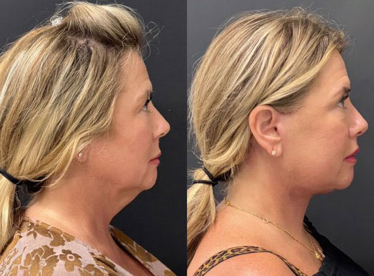Neck Lift before and after photos by Dr. Demetri Arnaoutakis in Tampa, FL