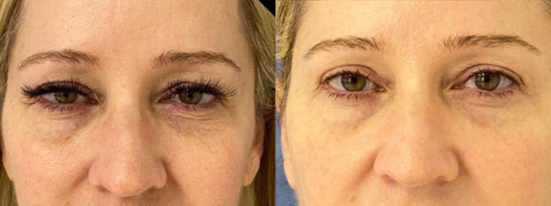 Eyelid Surgery before and after photos by Dr. Demetri Arnaoutakis in Tampa, FL