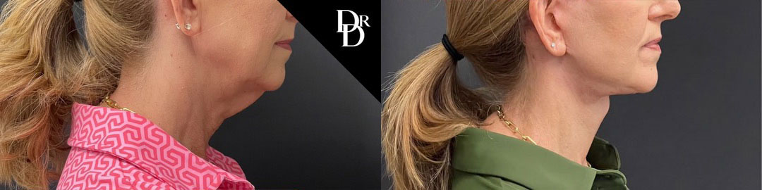 Facelift Before And After Photos By Dr. Demetri Arnaoutakis In Tampa, Fl