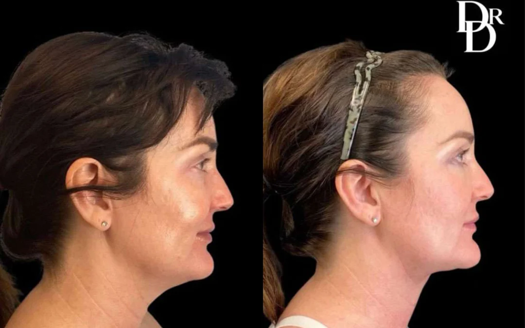 Facetite Before And After Photos By Dr. Demetri Arnaoutakis In Tampa, Fl