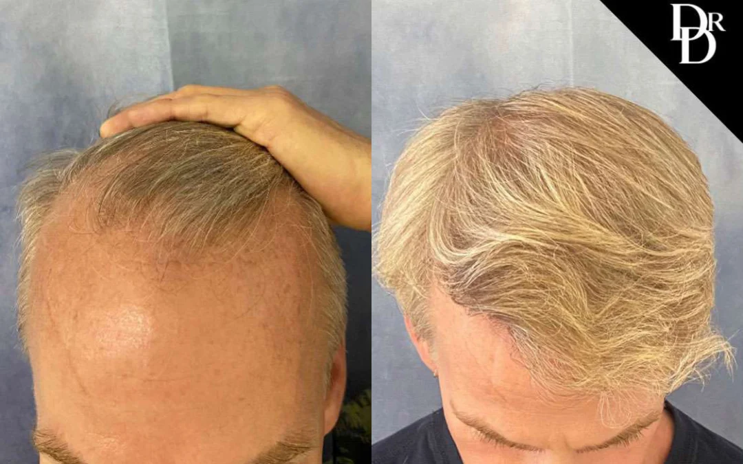 Hair Transplant Before And After Photos By Dr. Demetri Arnaoutakis In Tampa, Fl