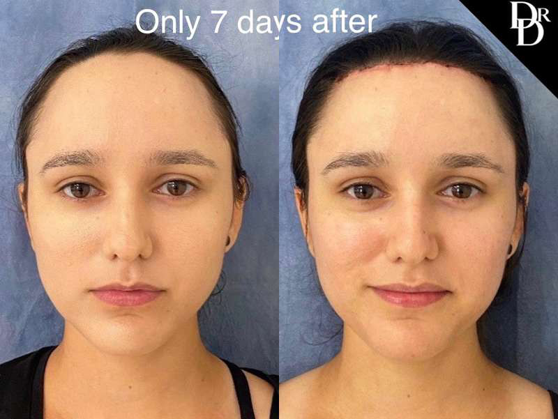 Hairline Lowering Surgery Before And After Photos By Dr. Demetri Arnaoutakis In Tampa, Fl