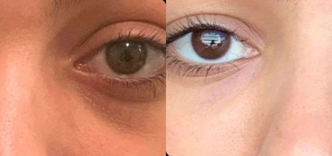 Injectable/Dermal Fillers Before And After Photos By Dr. Demetri Arnaoutakis In Tampa, Fl