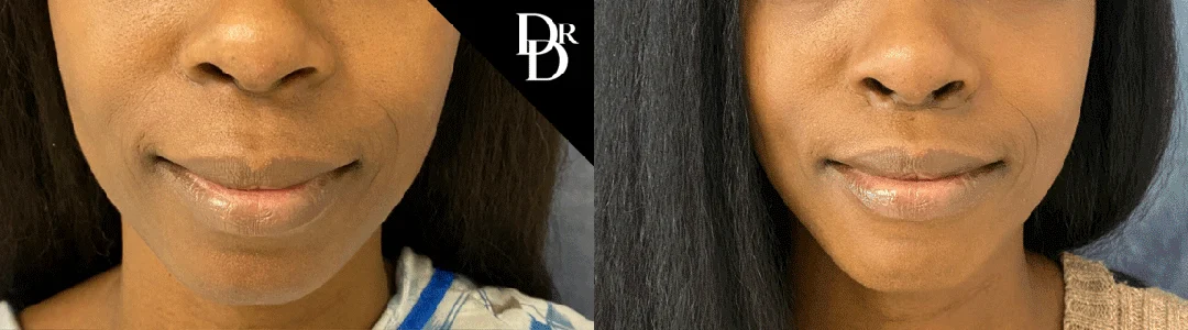 Lip Lift before and after photos by Dr. Demetri Arnaoutakis in Tampa, FL